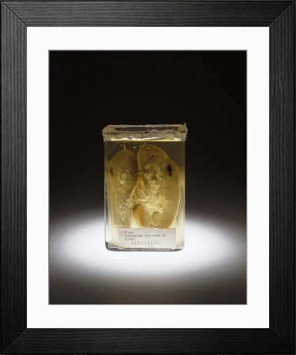 Framed Print : Kidney, Stab Wound, 1937
