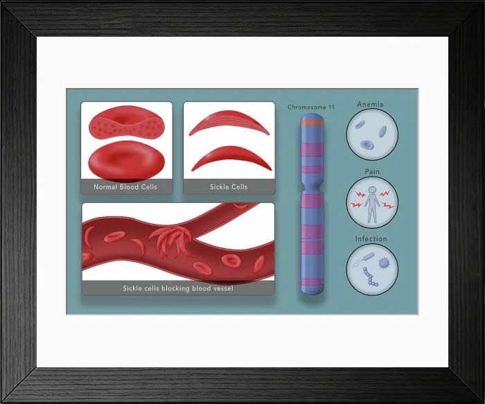 Framed Print : Diagram of Sickle Cell Anemia Disease, normal blood cells, sickle cells, genetics represented by chromosome 11 and symptoms such as pain and infection Framed Print : Diagram of Sickle Cell Anemia Disease, normal blood cells, sickle cells, genetics represented by chromosome 11 and symptoms such as pain and infection