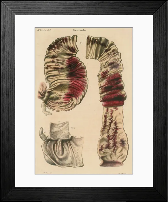 Framed Print : Cholera Infected Intestines, 1808