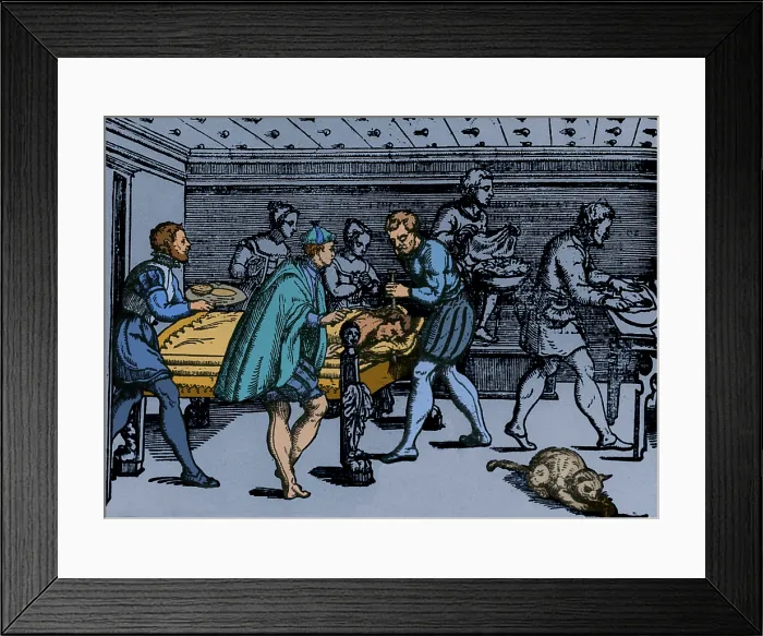 Framed Print : Earliest Depiction of Craniotomy, 1573