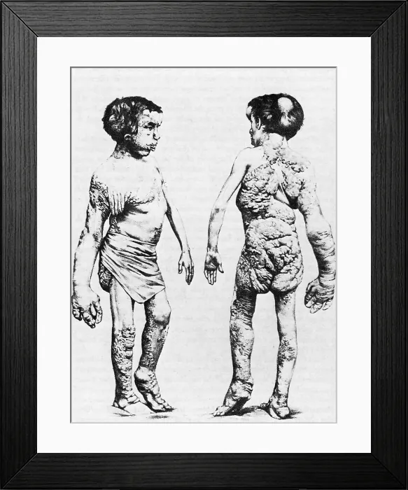 Framed Print : Joseph Merrick, The Elephant Man Framed Print : Joseph Merrick, The Elephant Man
