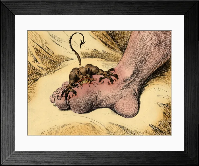 Framed Print : The Pain of Gout, 1799 Framed Print : The Pain of Gout, 1799