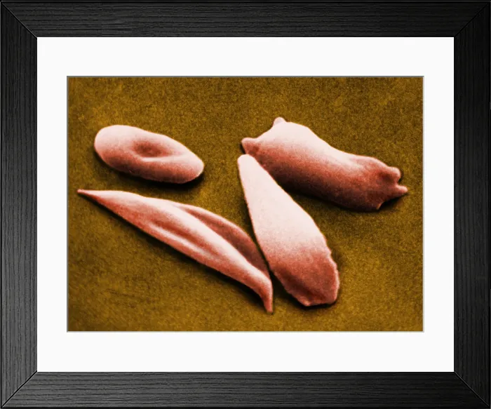 Framed Print : SCD, Sickle-Cell Anemia, under a microscope (SEM)