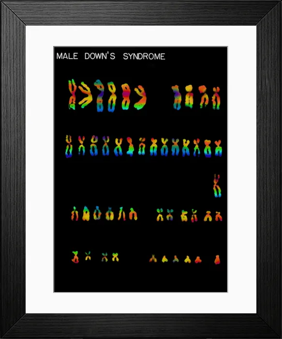Framed Print : Karyotype, Down Syndrome