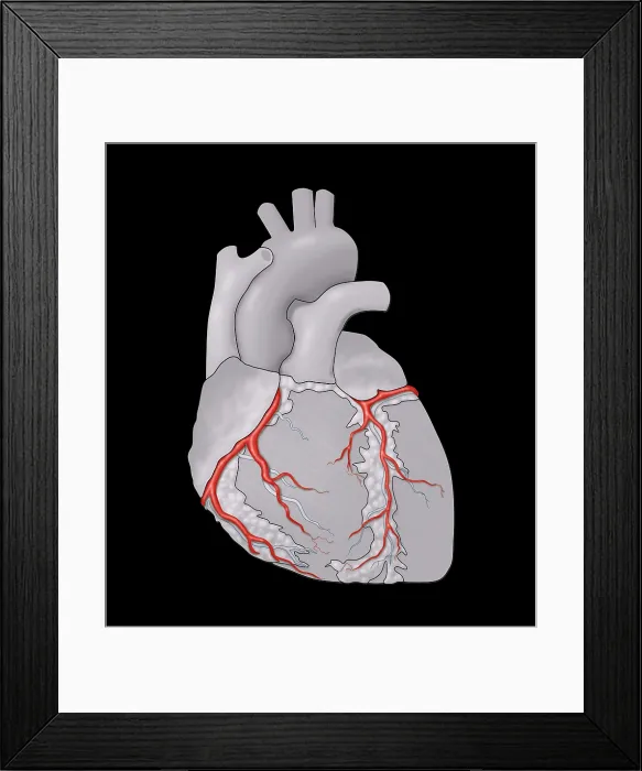 Framed Print : Coronary Arteries, Illustration Framed Print : Coronary Arteries, Illustration