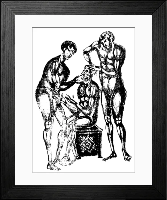Framed Print : Mandibular Dislocation, 1st Century BC Framed Print : Mandibular Dislocation, 1st Century BC