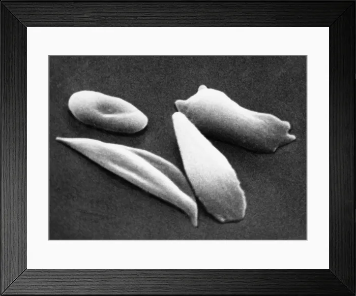 Framed Print : SCD, Sickle-Cell Anemia, under a microscope (SEM) Framed Print : SCD, Sickle-Cell Anemia, under a microscope (SEM)