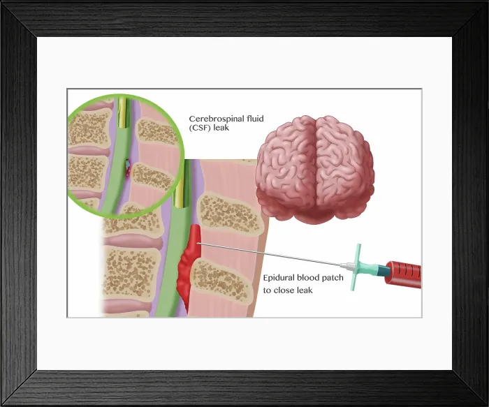Framed Print : Epidural Blood Patch Procedure, Illustration Framed Print : Epidural Blood Patch Procedure, Illustration