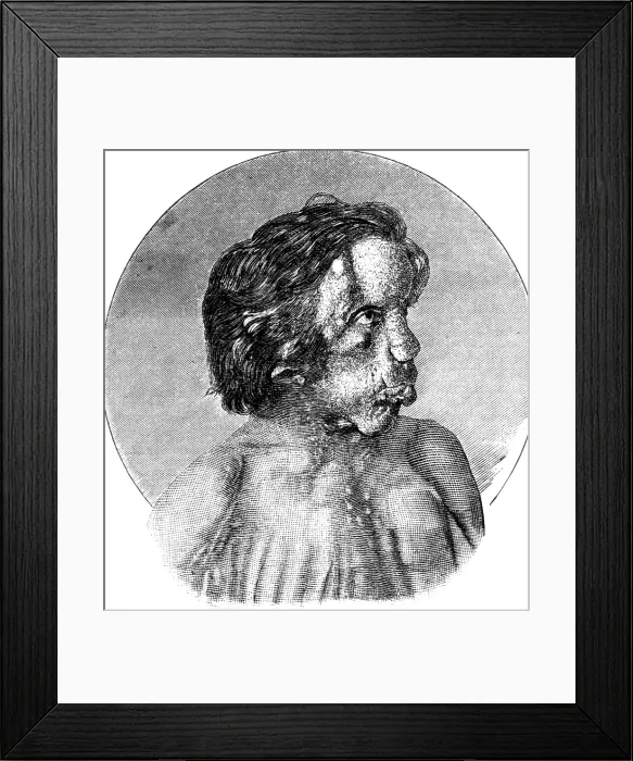 Framed Print : Joseph Merrick, The Elephant Man Framed Print : Joseph Merrick, The Elephant Man