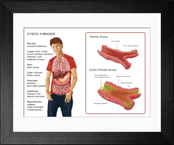 Framed Print : Cystic Fibrosis Framed Print : Cystic Fibrosis