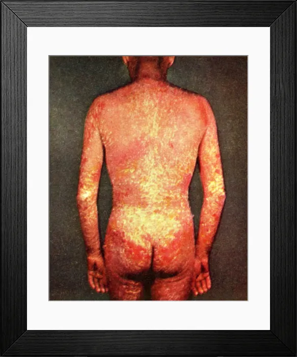 Framed Print : Erythroderma Framed Print : Erythroderma