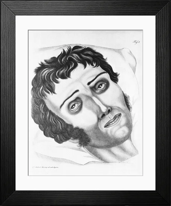 Framed Print : Cholera Victim, 1831
