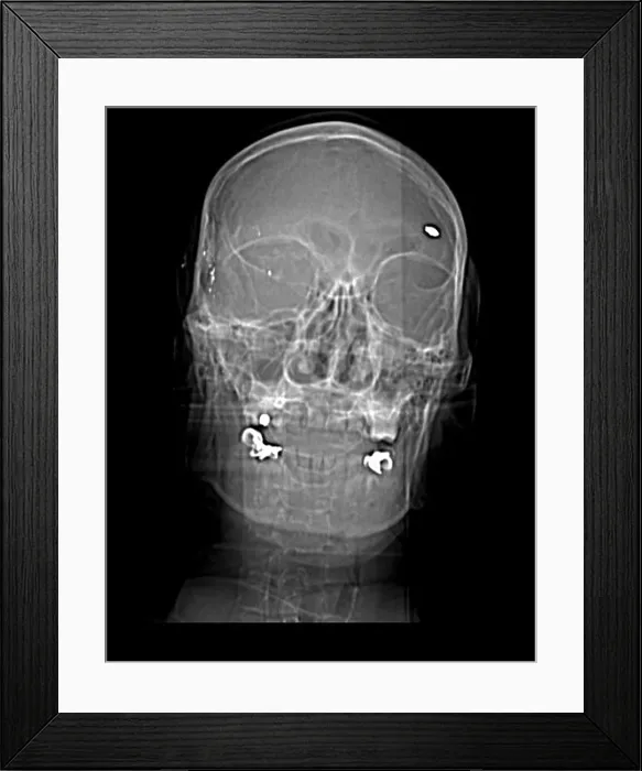 Framed Print : CT Scout View, Bullet Fragments Framed Print : CT Scout View, Bullet Fragments