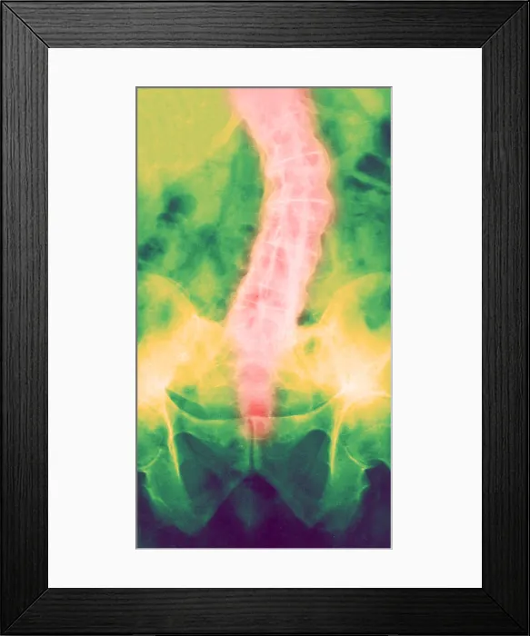 Framed Print : Ankylosing Spondylitis, X-Ray Framed Print : Ankylosing Spondylitis, X-Ray