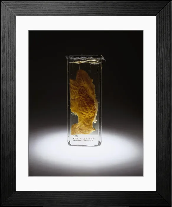 Framed Print : Stomach, Hemorrhagic Gastritis, Arsenic Poisoning, 1934 Framed Print : Stomach, Hemorrhagic Gastritis, Arsenic Poisoning, 1934