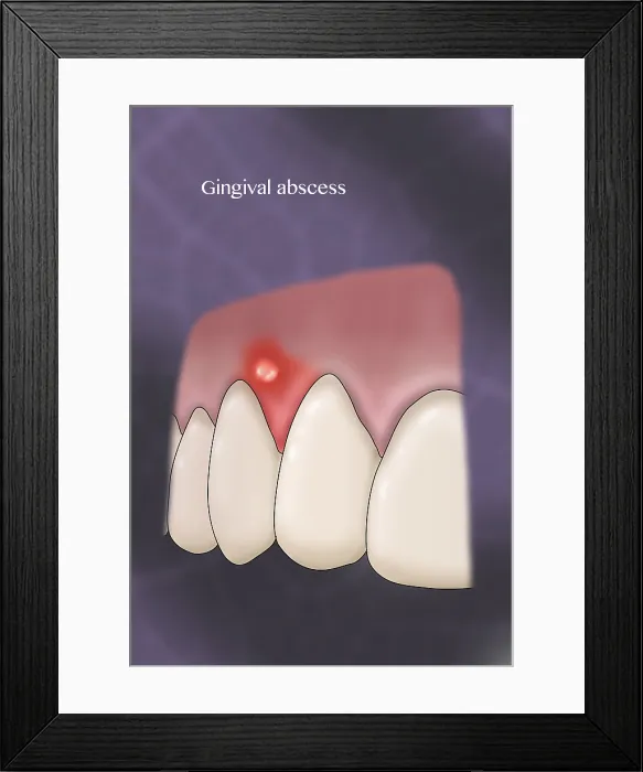 Framed Print : Gingival Abscess, Illustration Framed Print : Gingival Abscess, Illustration