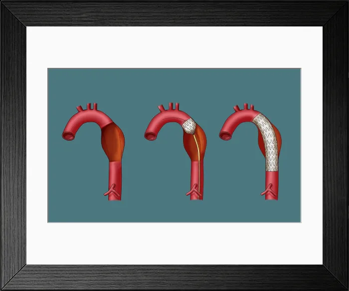 Framed Print : Aortic Aneurysm Stent, Illustration Framed Print : Aortic Aneurysm Stent, Illustration