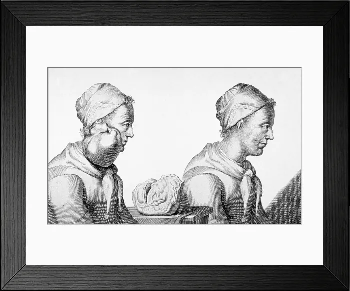 Framed Print : Surgical Removal of Tumor, 1689 Framed Print : Surgical Removal of Tumor, 1689