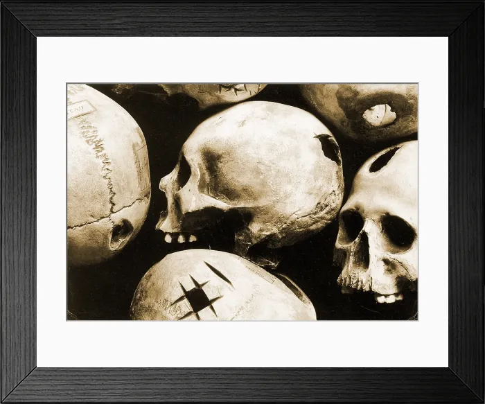 Framed Print : Skulls Showing Trepanation