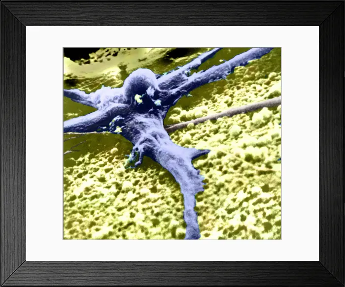 Framed Print : Malignant cancer cell Framed Print : Malignant cancer cell