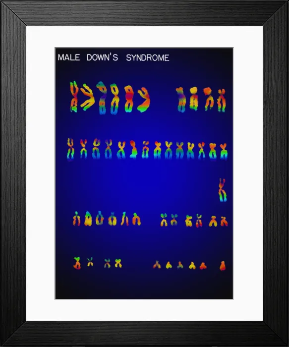 Framed Print : Karyotype, Down Syndrome