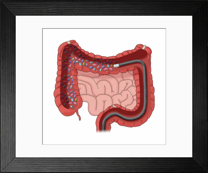 Framed Print : Colonoscopy Administering a Fecal Microbiota Transplantation (FMT) in the large intestine to improve the human microbiome, medical illustration Framed Print : Colonoscopy Administering a Fecal Microbiota Transplantation (FMT) in the large intestine to improve the human microbiome, medical illustration