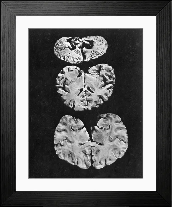 Framed Print : Minamata Disease Framed Print : Minamata Disease