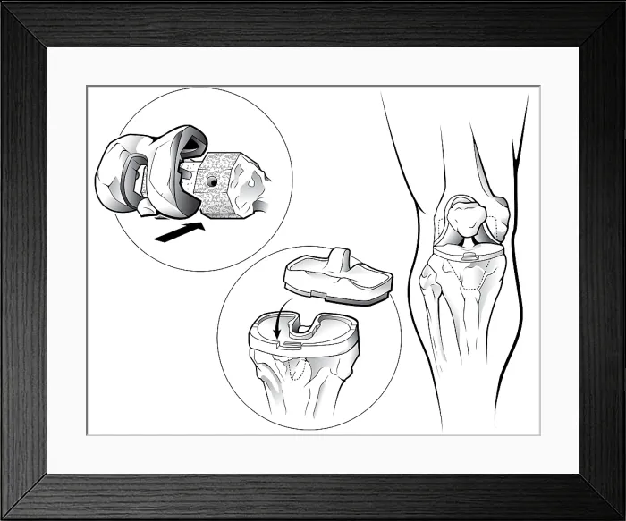 Framed Print : Total Knee Replacement (Prosthetic) Framed Print : Total Knee Replacement (Prosthetic)