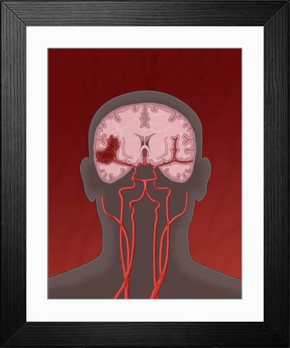 Framed Print : Hemorrhagic Stroke, Illustration