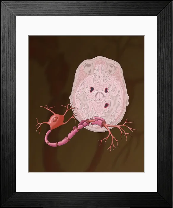 Framed Print : Multiple Sclerosis Framed Print : Multiple Sclerosis