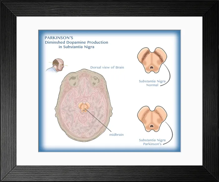 Framed Print : Parkinson's disease illustration shows diminished dopamine transmission in neurons and the substantia nigra region of the brain