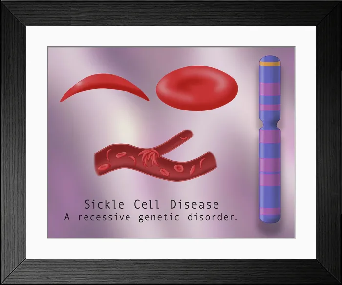 Framed Print : Sickle cell anemia disease, a normal blood cell, a sickle shaped blood cell, a clogged artery or blood vessel, adn genetics represented by chromsome 11, illustration Framed Print : Sickle cell anemia disease, a normal blood cell, a sickle shaped blood cell, a clogged artery or blood vessel, adn genetics represented by chromsome 11, illustration