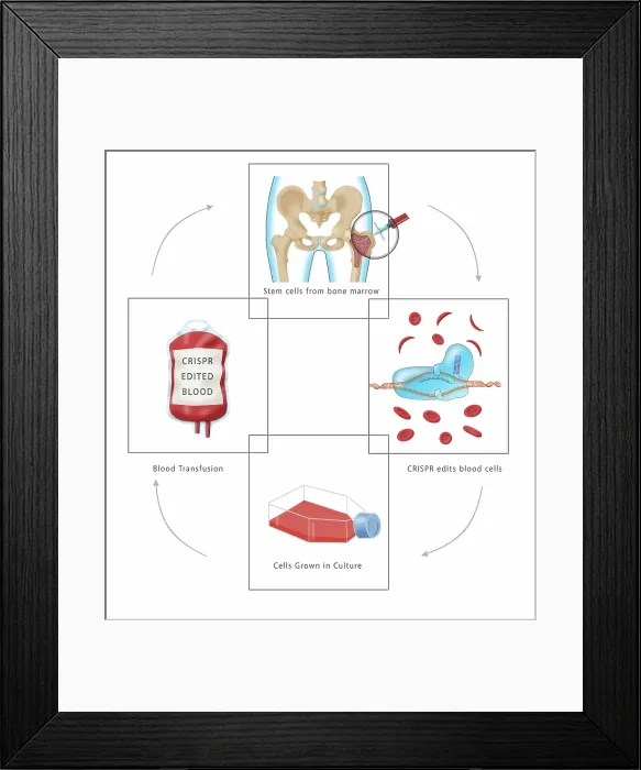 Framed Print : Diagram of CRISPR gene therapy as a Sickle Cell Anemia Disease cure through a transfusion, bone marrow aspiration, medical illustration Framed Print : Diagram of CRISPR gene therapy as a Sickle Cell Anemia Disease cure through a transfusion, bone marrow aspiration, medical illustration