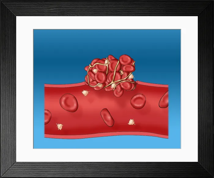 Framed Print : Blood clot