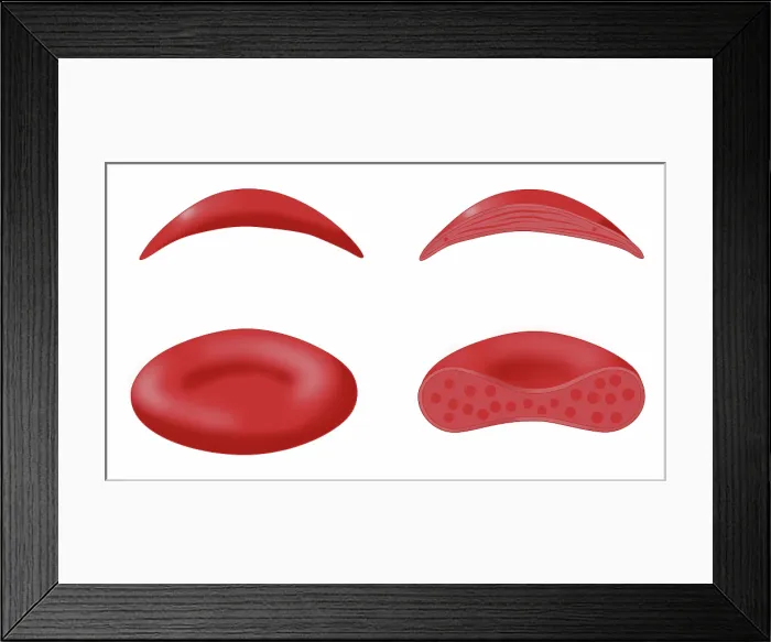 Framed Print : Sickle cell anemia disease, a normal blood cell, a sickle shaped blood cell, illustration Framed Print : Sickle cell anemia disease, a normal blood cell, a sickle shaped blood cell, illustration
