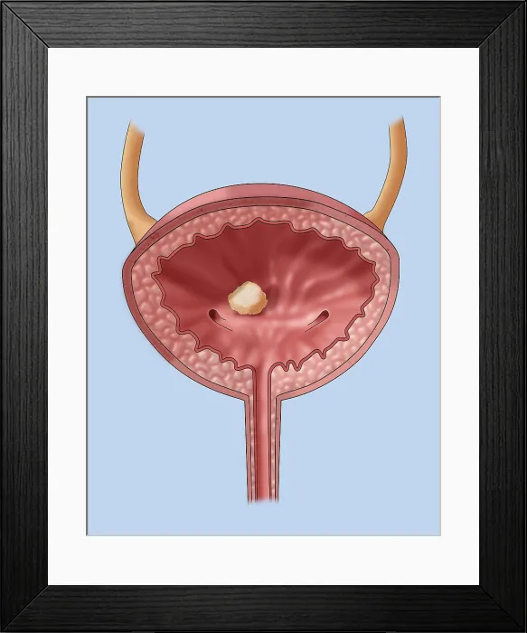 Framed Print : Bladder Stone, Illustration