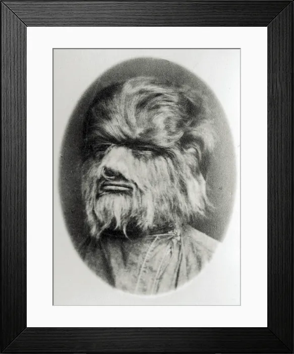 Framed Print : Hypertrichosis, 19th Century