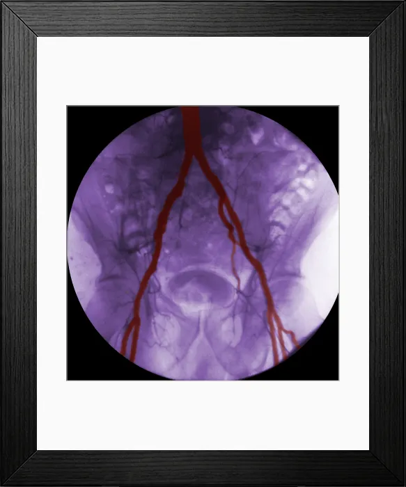 Framed Print : Angiogram of Iliac Arteries