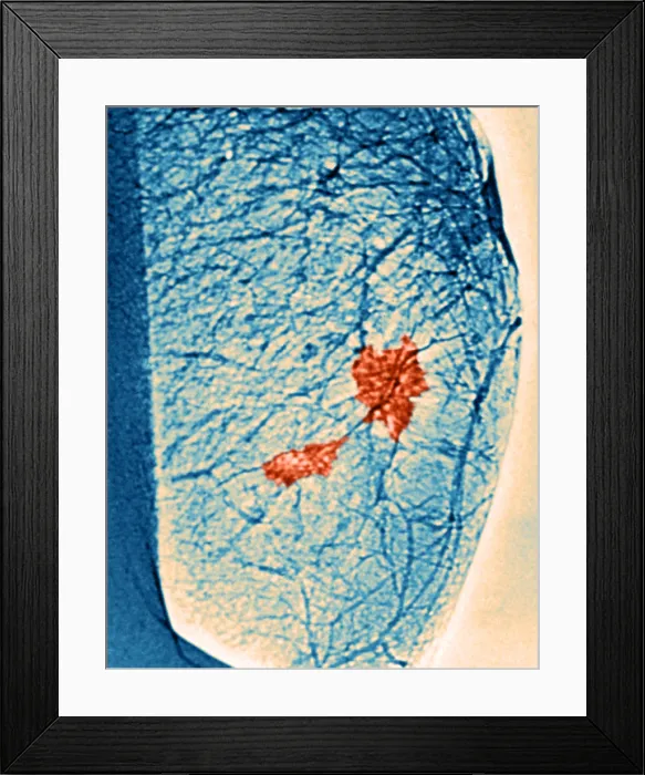Framed Print : Mammogram. Color enhanced mammogram showing tumors in the breast tissue Framed Print : Mammogram. Color enhanced mammogram showing tumors in the breast tissue