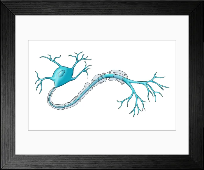 Framed Print : Nerve Demyelination of the myelin sheath, causes include multiple sclerosis (MS) disease, toxins, infections, Illustration Framed Print : Nerve Demyelination of the myelin sheath, causes include multiple sclerosis (MS) disease, toxins, infections, Illustration