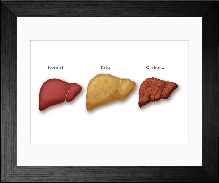 Framed Print : Liver Disease Progression, Illustration Framed Print : Liver Disease Progression, Illustration