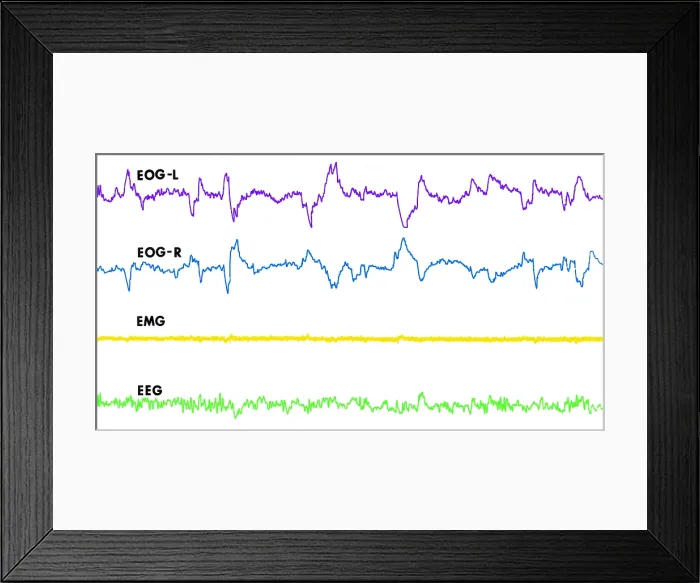 Framed Print : Polygraph Tracings of REM Sleep Framed Print : Polygraph Tracings of REM Sleep