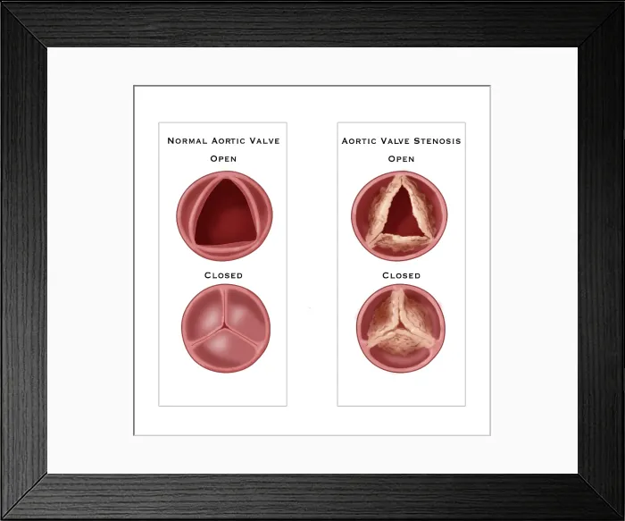 Framed Print : Aortic Valve Comparison Framed Print : Aortic Valve Comparison
