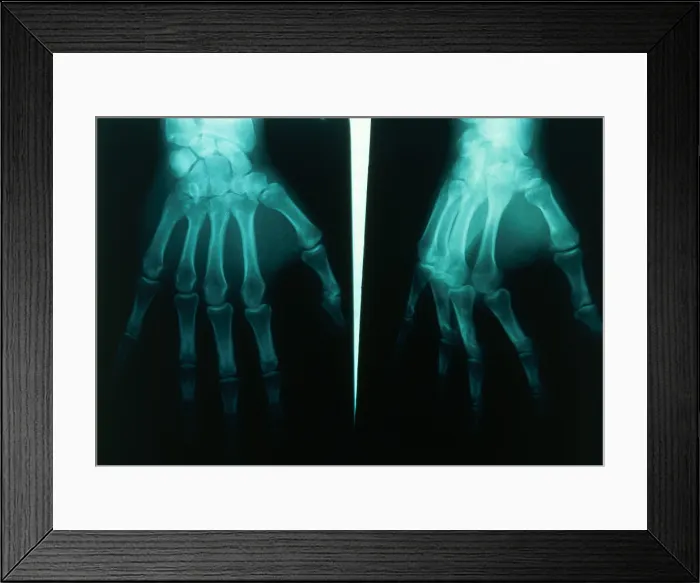 Framed Print : Arthritic & Normal Hand Framed Print : Arthritic & Normal Hand
