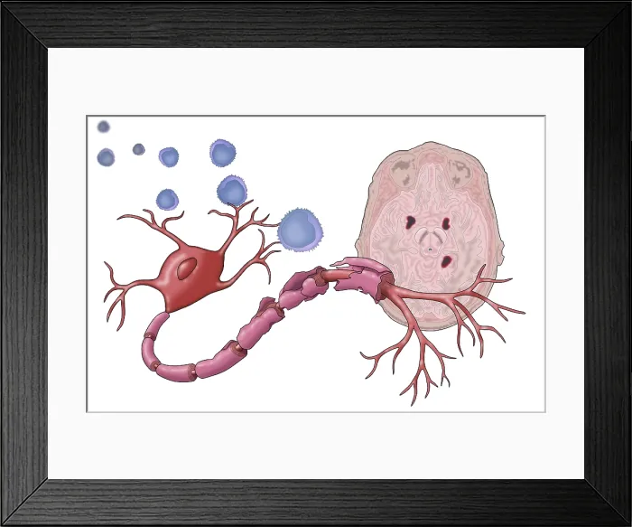 Framed Print : Multiple Sclerosis Framed Print : Multiple Sclerosis