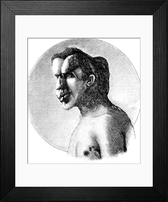 Framed Print : Joseph Merrick, The Elephant Man