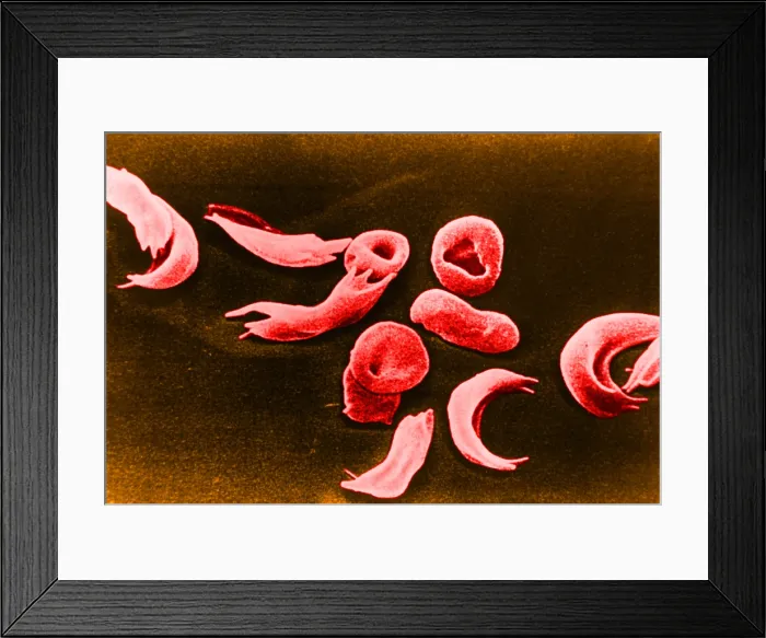 Framed Print : SCD, Sickle-Cell Anemia, under a microscope (SEM) Framed Print : SCD, Sickle-Cell Anemia, under a microscope (SEM)