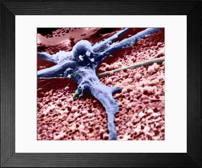 Framed Print : Malignant cancer cell