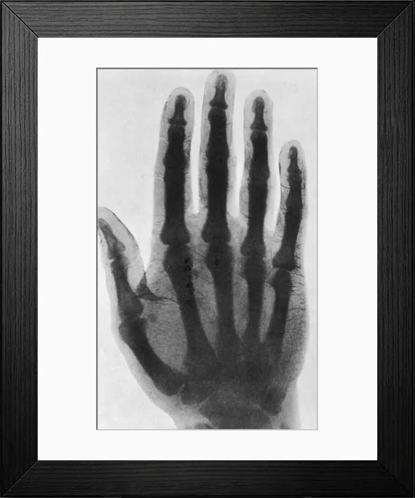Framed Print : Early X-ray, 1897 Framed Print : Early X-ray, 1897