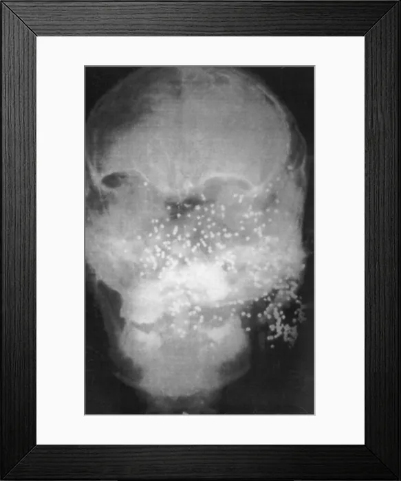 Framed Print : Forensic X-Ray of Murder Victim Framed Print : Forensic X-Ray of Murder Victim